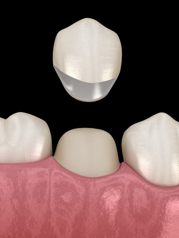 dental crown cost