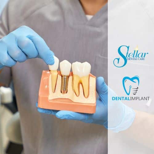 Dental Implants Near Me- Cosmetic Dentistry in Buffalo New York Stellar Dental Care
