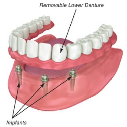 Affordable dentures near me in Buffalo New York stellar Dental care.