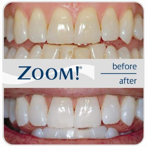 Zoom Professional Teeth Whitening cost Before and After