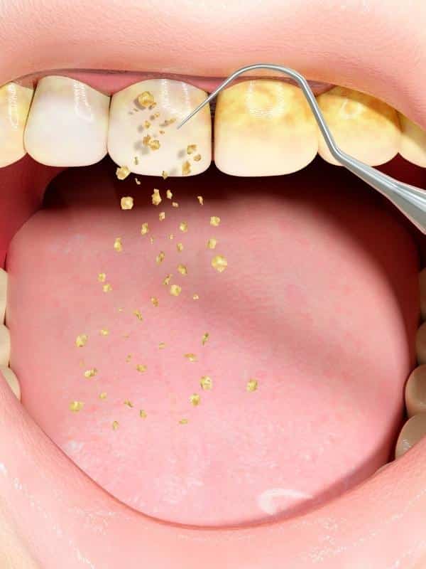 periodontal-disease-treatment with Stellar Dental Care