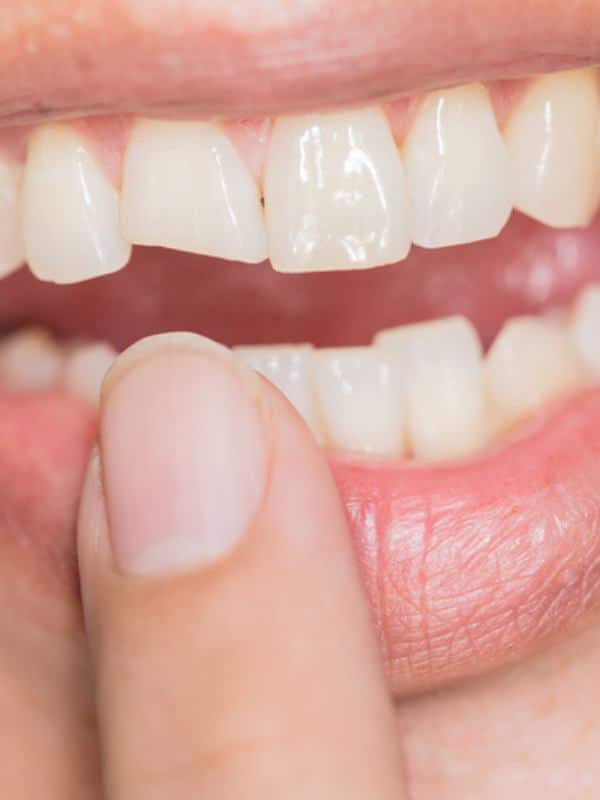 Chipped tooth repair