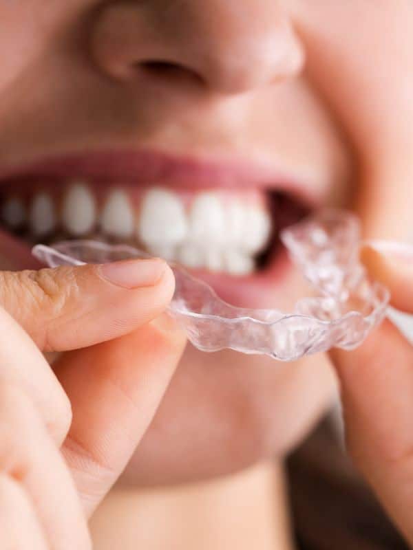 Clear aligner Cost in Buffalo New York