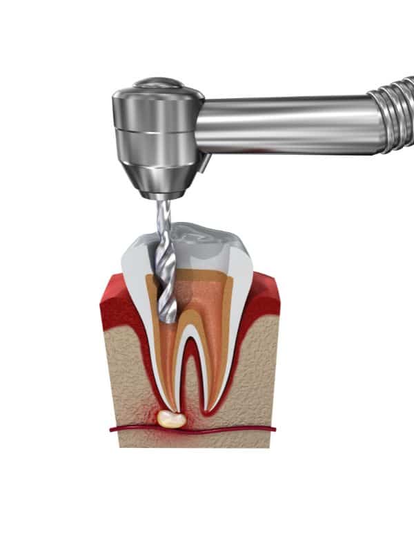 root canal costs