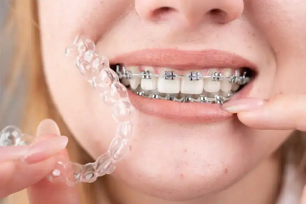 Invisalign®: A Clear Solution for a Perfect Smile