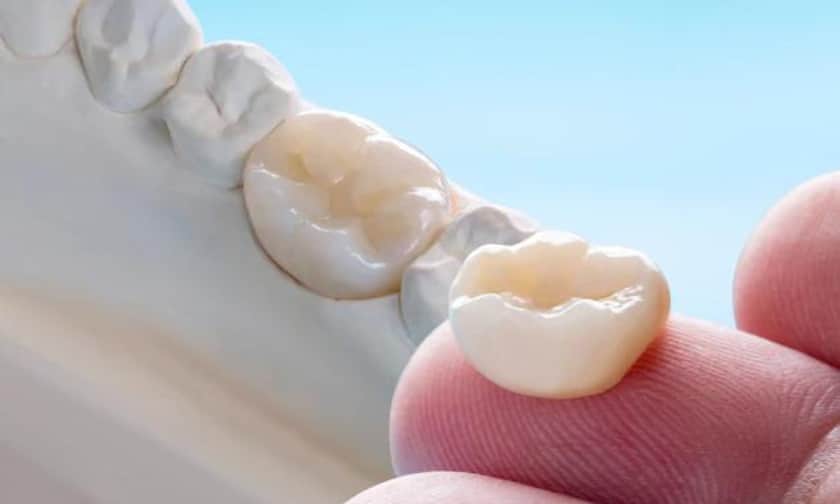 Choosing the Right Material for Your Dental Crowns: Guide & Tips