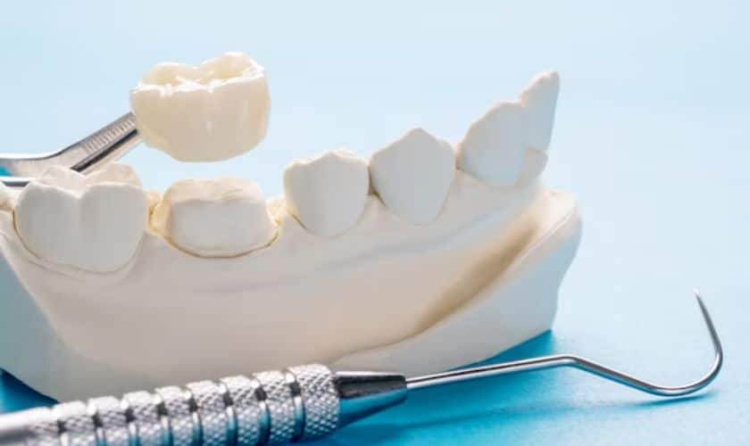 Dental Crowns: Restoring Your Smile with Stellar Dental Care