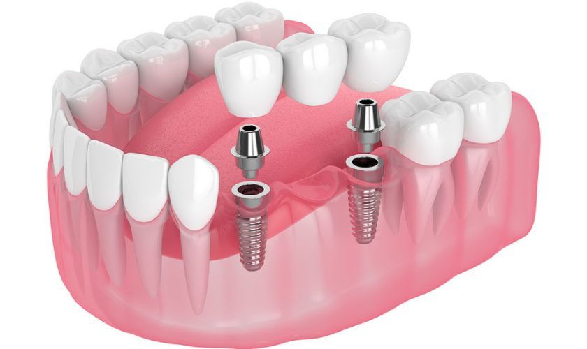 Discover the Benefits of Dental Implants at Stellar Dental Care