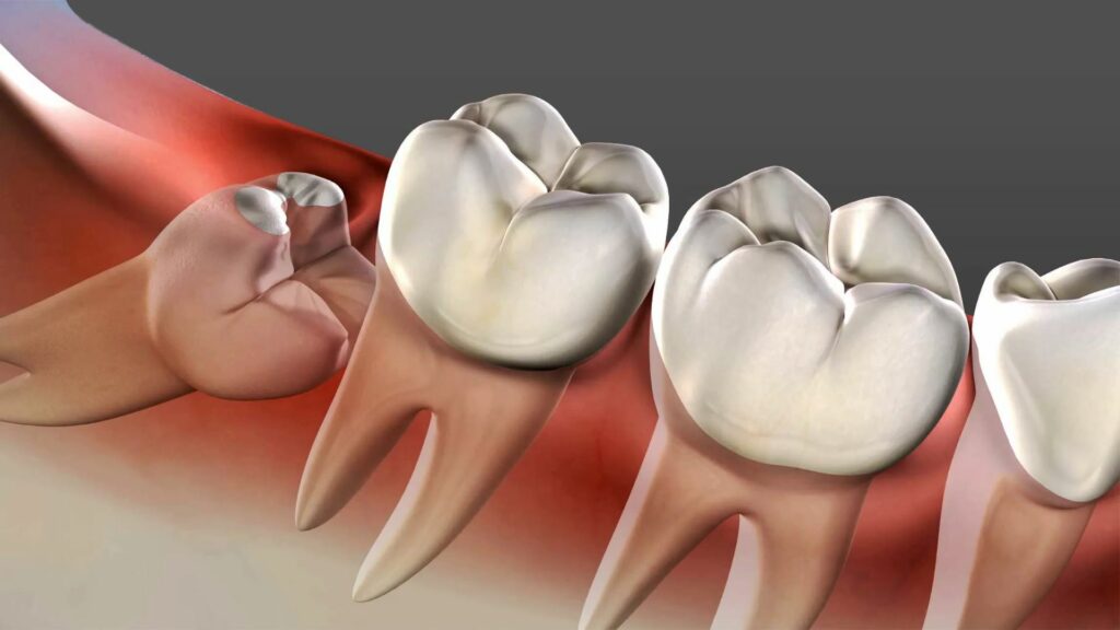Understanding Toothaches and Effective Treatment Options