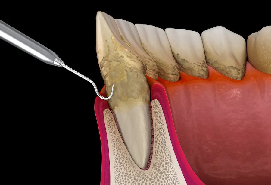 Effective Gum Disease Treatments for Healthier Gums