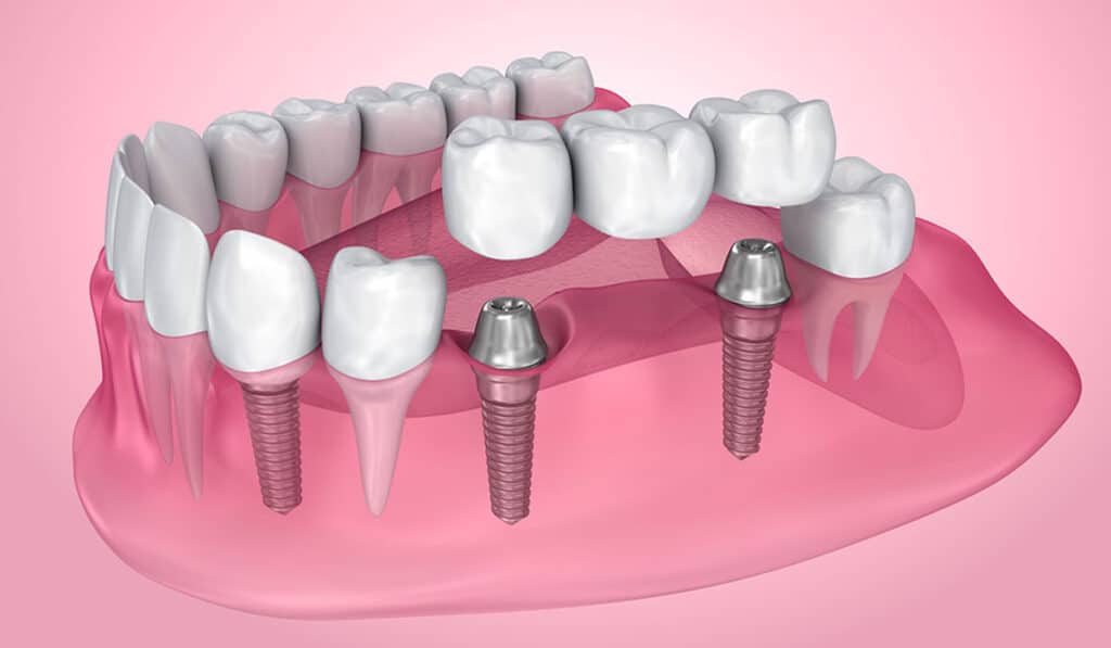 Key Facts About Dental Implants