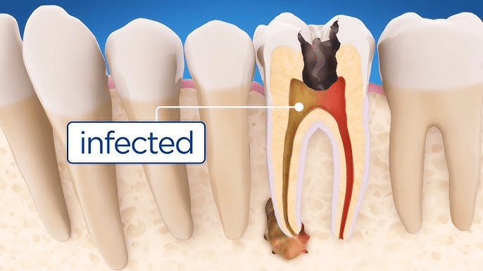 Understanding Root Canal Treatment