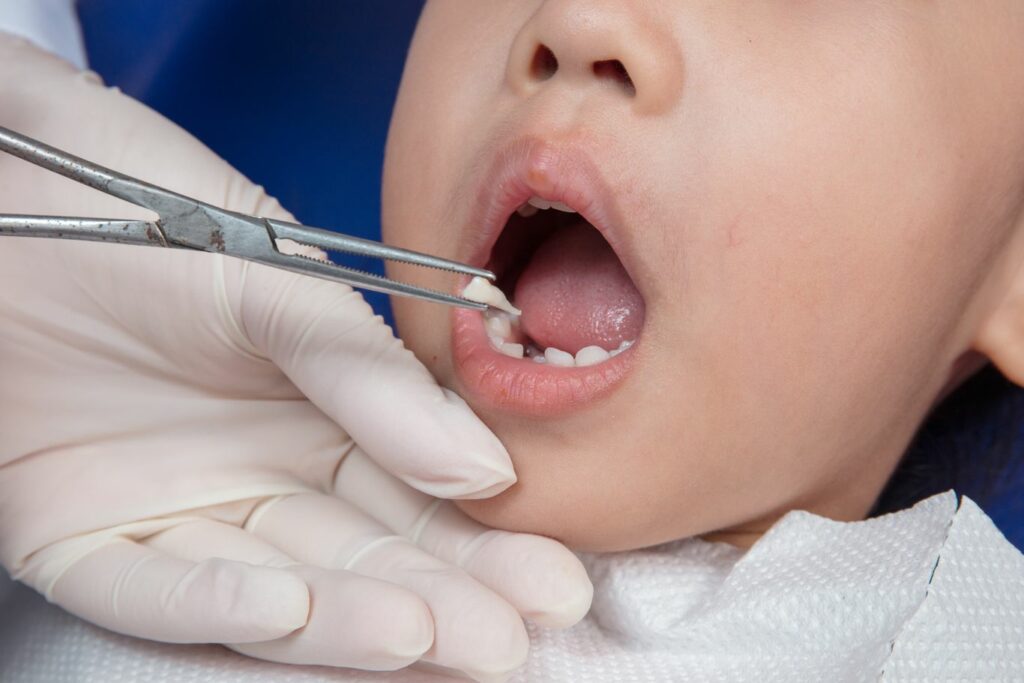 The Tooth Extraction Process What Kids Should Know