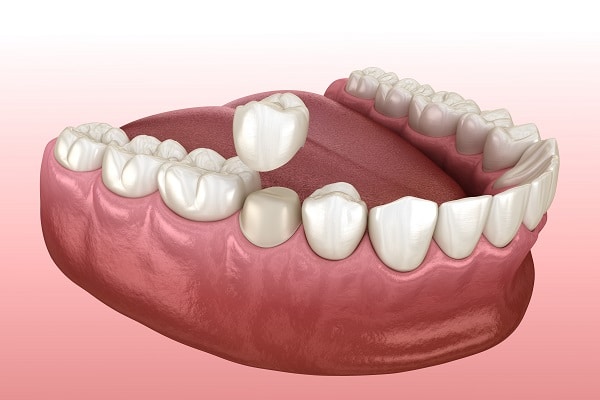 How Dental Crowns Restore and Protect Teeth