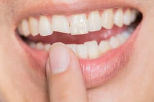 Chipped Tooth
