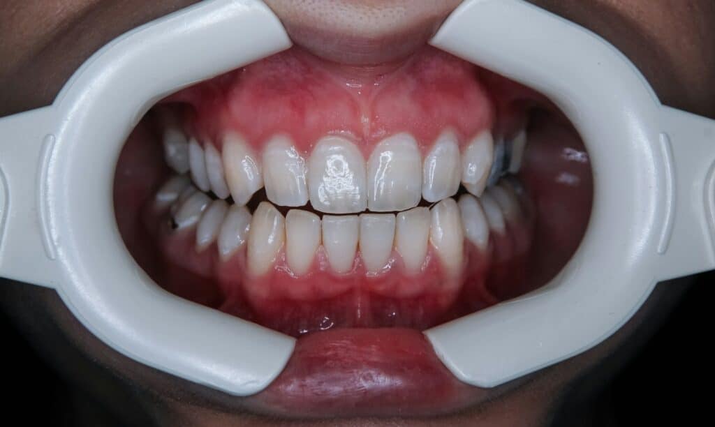 Teeth